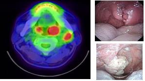 ▲ 편도암의 PET-CT 영상(왼쪽)과 내시경 사진(오른쪽) (서울성모병원 제공=연합뉴스)