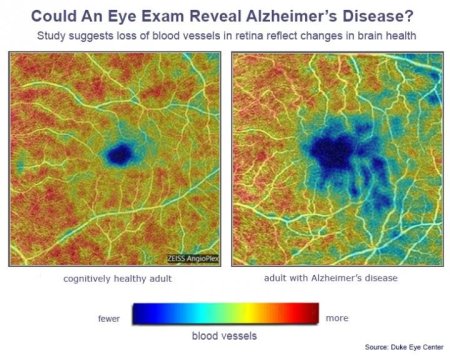 ▲ 왼쪽은 정상인, 오른쪽은 치매 환자의 망막 미세 혈관 밀도. 붉은색은 밀도가 높고 푸른색은 낮다. [출처:
미국 듀크 안센터]