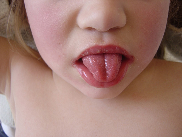 성홍열 이미지. 클립아트코리아 제공. 